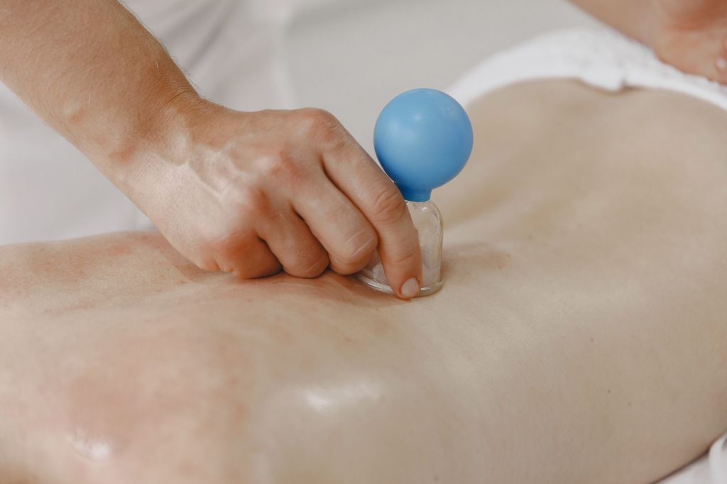 Close-up of cupping therapy cups on the back, showing the marks left after fire or blood cupping