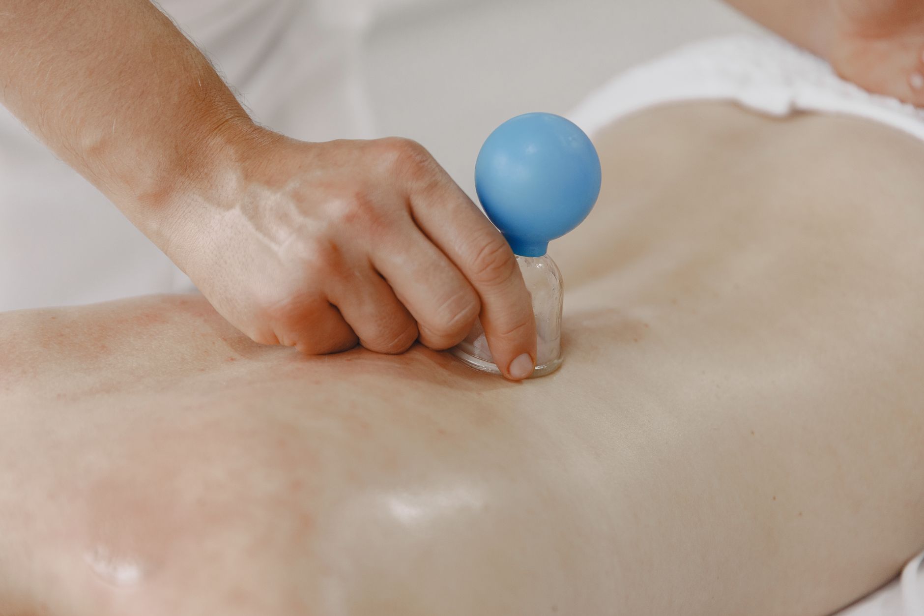 Close-up of cupping therapy cups on the back, showing the marks left after fire or blood cupping