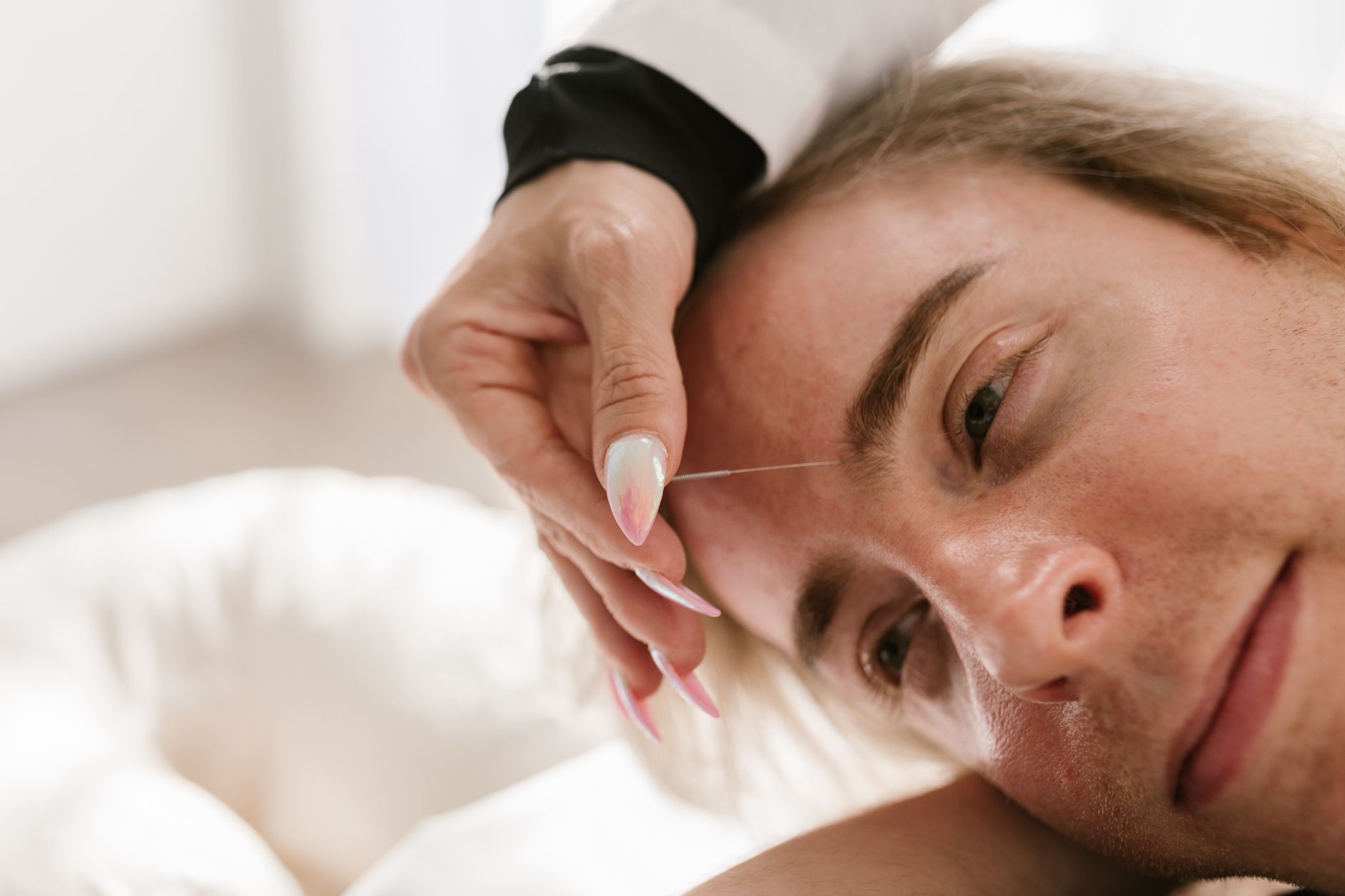 Close-up of facial acupuncture needles used for natural facial rejuvenation, compared to Botox